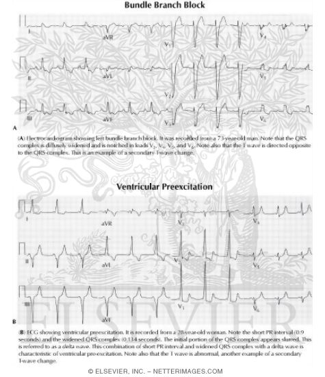 Watermarked preview of unlabeled image: Bundle Branch Block and Ventricular Preexcitation