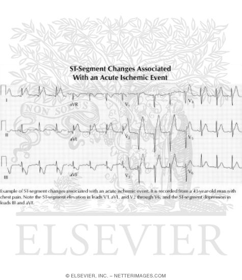 Watermarked preview of unlabeled image: ST-Segment Changes Associated With an Acute Ischemic Event