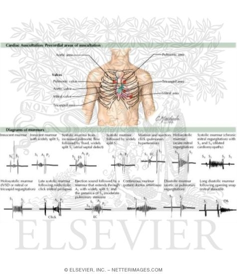 Cardiac Auscultation: Precordial Areas of Auscultation