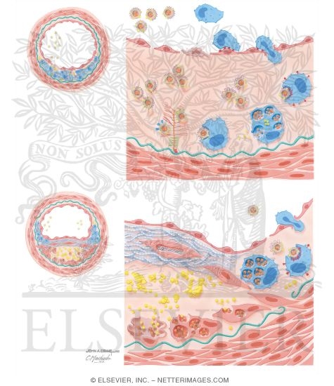 Watermarked preview of unlabeled image: Atherogenesis
