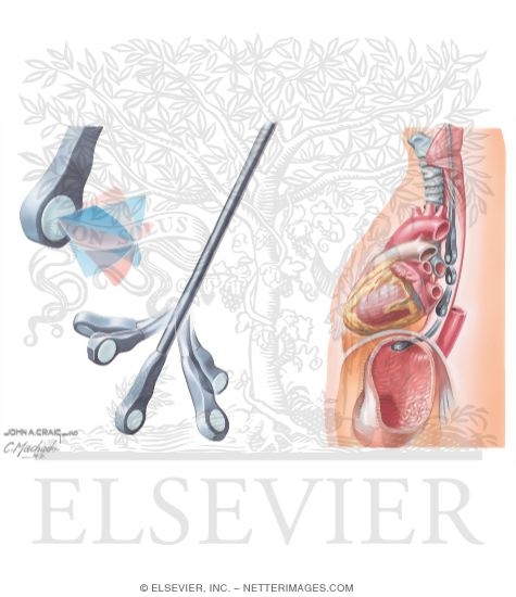 Transesophageal Echocardiography