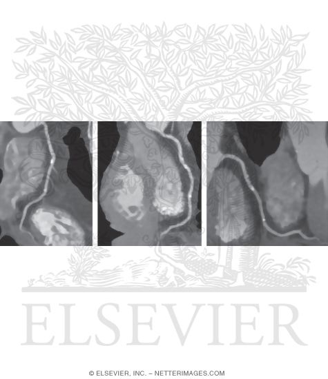 Watermarked preview of unlabeled image: Computed Tomography (CT) Coronary Angiography