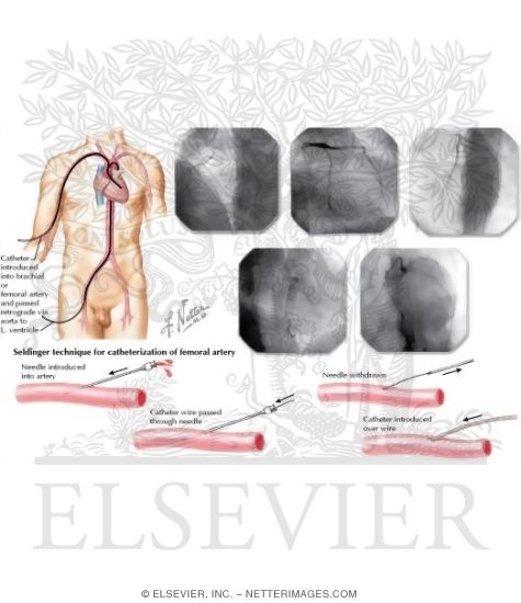 Left-Sided Heart Catheterization