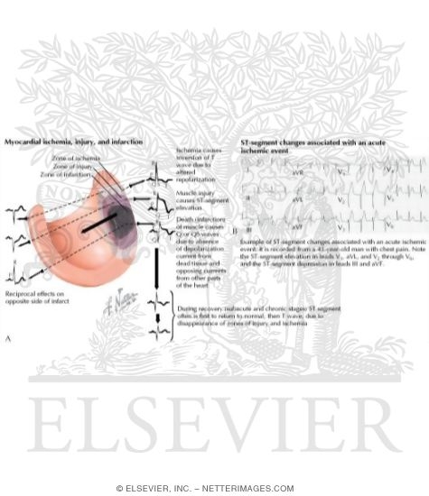 Effect of Cardiac Infarction, Injury, and Ischemia
Myocardial Ischemia, Injury, and Infarction