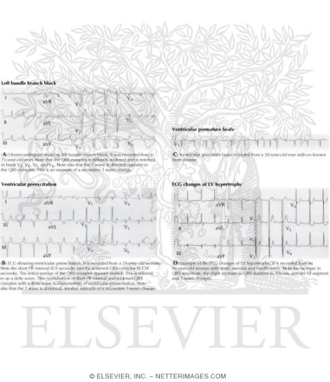QRS Complex