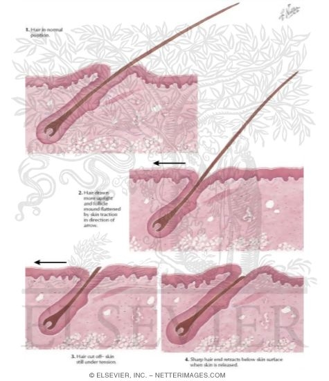 Watermarked preview of labeled image: Shaving: A Cause of Skin Disorders