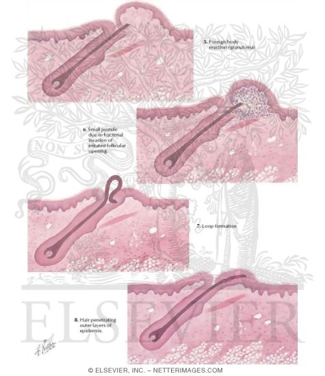 Watermarked preview of labeled image: Shaving: A Cause of Skin Disorders