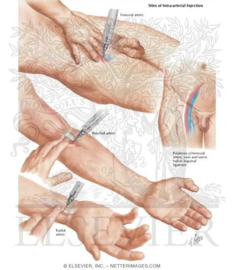 Intraarterial Priscoline