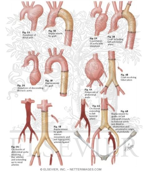 Watermarked preview of labeled image: Surgery of Aorta