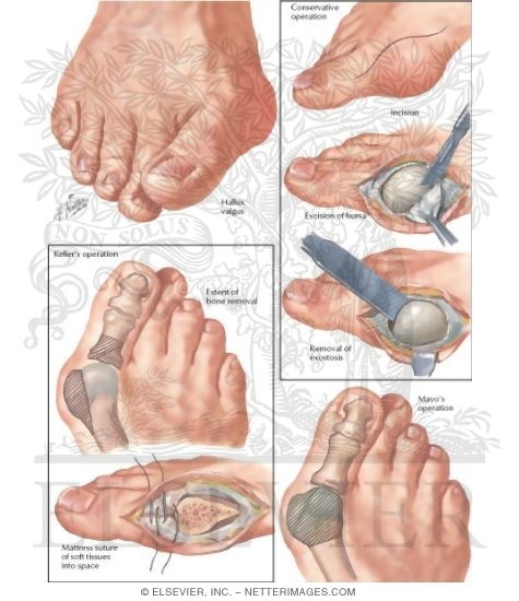 Watermarked preview of labeled image: Operations for Hallux Valgus