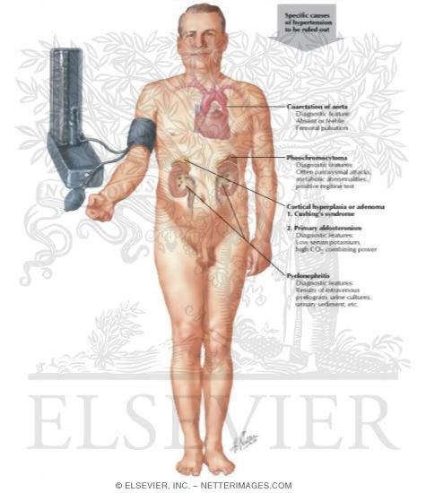 Watermarked preview of labeled image: Specific Causes of Hypertension to be Ruled Out