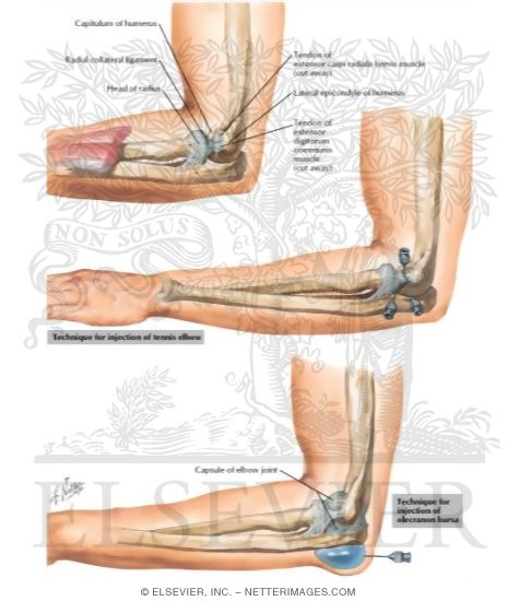 Watermarked preview of labeled image: Tennis Elbow