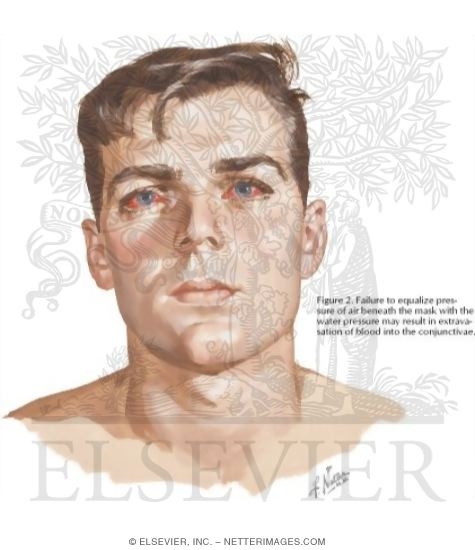 Watermarked preview of labeled image: Extravasation of Blood Into the Conjunctivae