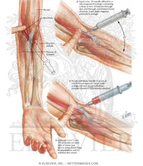 Technique of Arterial Puncture