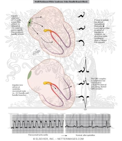 Wolff - Parkinson - White Syndrome