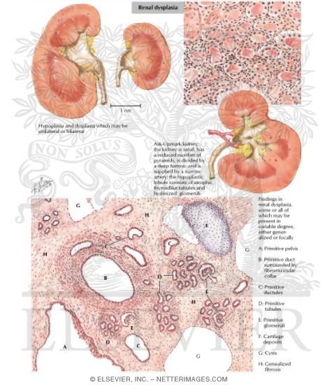 Watermarked preview of labeled image: Renal Dysplasia