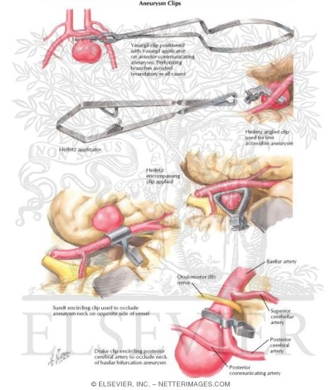 Aneurysm Clips