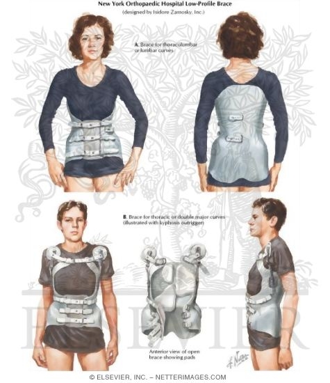 Watermarked preview of labeled image: New York Orthopaedic Hospital Low-Profile Brace