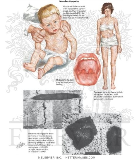 Nemaline Myopathy