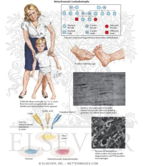 Metachromatic Leukodystrophy