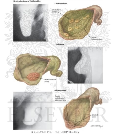 Watermarked preview of labeled image: Gallstones Benign Lesions of Gallbladder