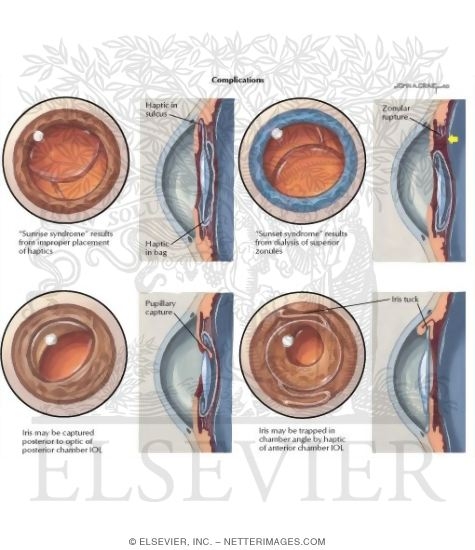Watermarked preview of labeled image: Cataracts Intraocular Lens (IOL)