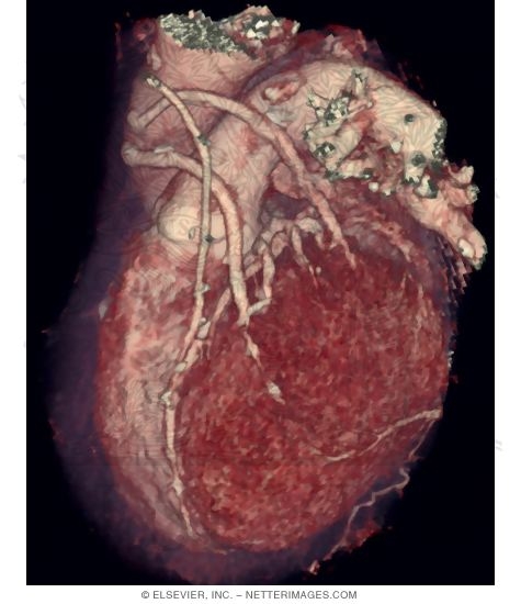 Watermarked preview of unlabeled image: 3D Cardiac Computed Tomography Volume Rendering