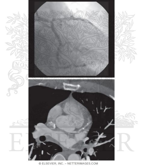 Watermarked preview of unlabeled image: Conventional Diagnostic Coronary Angiogram and Coronary Computed Tomography (CT) Angiogram