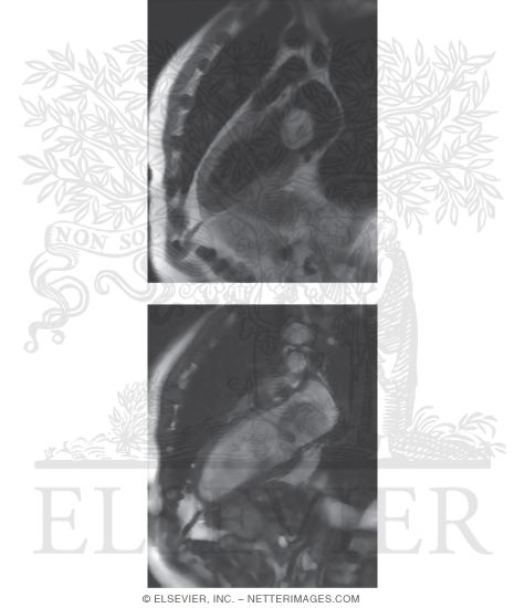 Watermarked preview of unlabeled image: Blood Sequences Showing Left Atrial Myxoma