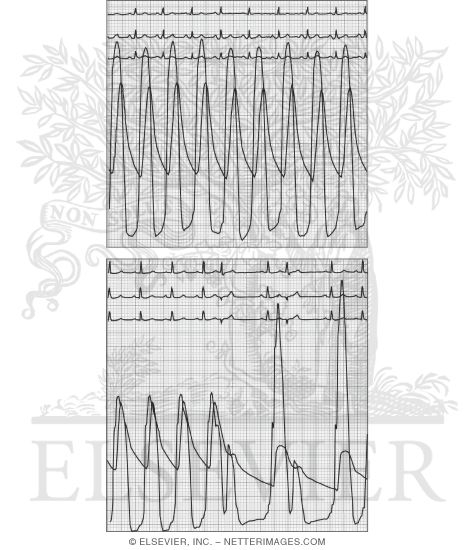 Simultaneous Pressure Tracings From the Left Ventricular Apex and Aorta In Aortic Stenosis