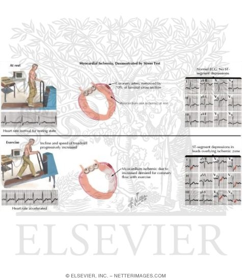 Watermarked preview of labeled image: Stress Test Segment Depressions
Testing to Detect Myocardial Ischemia