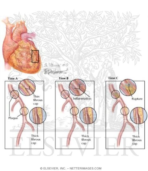 Identifying the Unstable Plaque