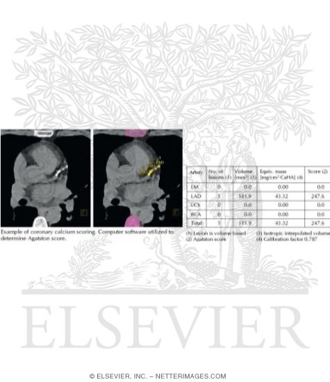 Watermarked preview of unlabeled image: Coronary Calcium Scoring