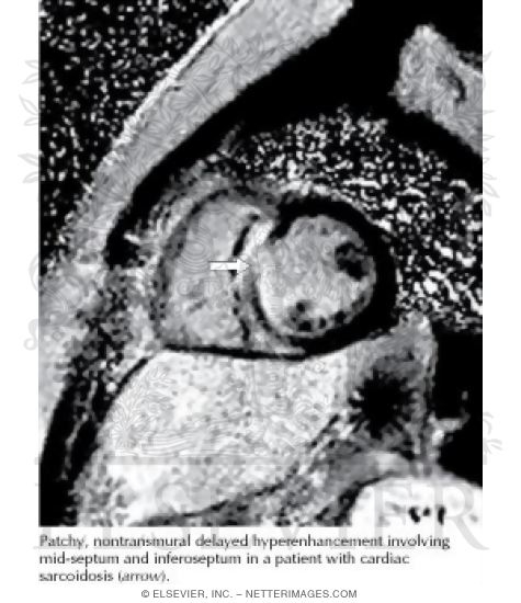 Watermarked preview of unlabeled image: Sarcoidosis: CMR Phase-sensitive Inversion Recovery