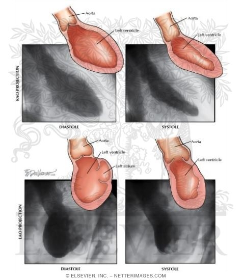 Watermarked preview of labeled image: Measurement of Left Ventricular Function Using Ventriculography
