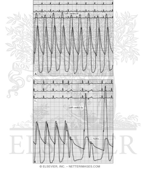 Watermarked preview of unlabeled image: Simultaneous Pressure Tracings From the Left Ventricular Apex and Aorta In Aortic Stenosis