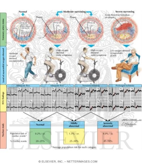 Watermarked preview of labeled image: The Degrees of Flow-limiting Atherosclerosis and Plaque Rupture