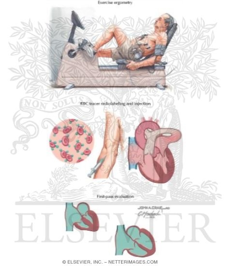 Watermarked preview of unlabeled image: Functional Testing Exercise Radionuclear Ventriculograms (RVG)