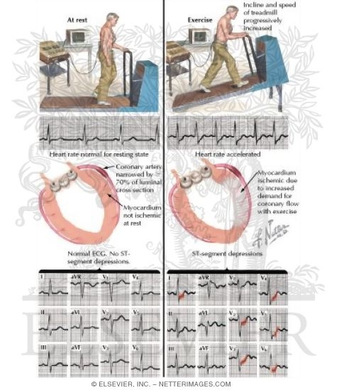 Watermarked preview of labeled image: Stress Test Segment Depressions
Testing to Detect Myocardial Ischemia