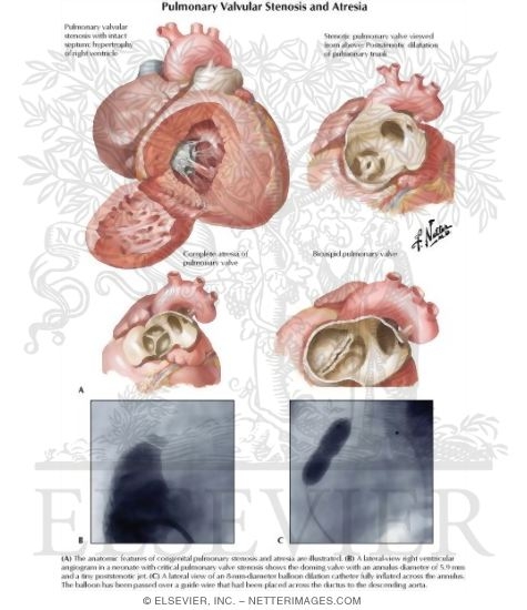 Watermarked preview of labeled image: Anomalies of the Right Ventricular Outflow Tract
Pulmonary Valvular Stenosis and Atresia