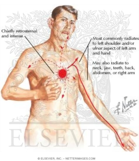 Pain of Myocardial Ischemia
