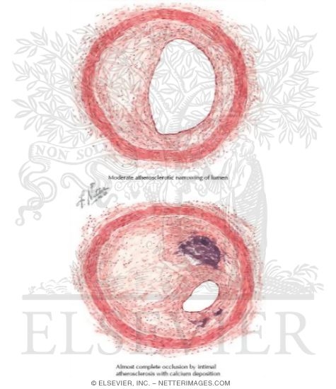 Watermarked preview of labeled image: Types and Degrees of Coronary Atherosclerotic Narrowing or Occlusion
