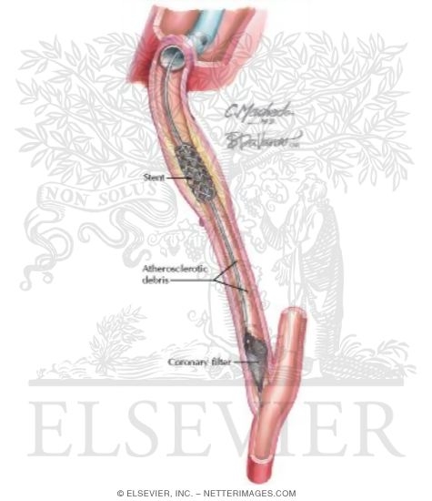 Watermarked preview of unlabeled image: Distal Protection Device: Coronary Filter