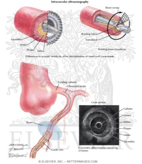 Intravascular Ultrasound