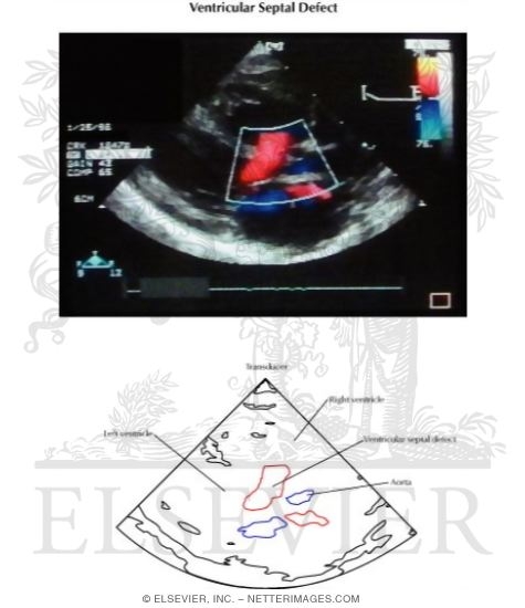 Watermarked preview of labeled image: Ventricular Septal Defect