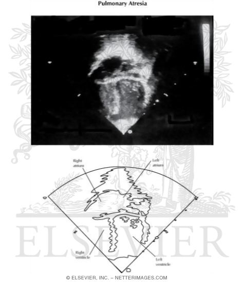 Watermarked preview of labeled image: Pulmonary Atresia