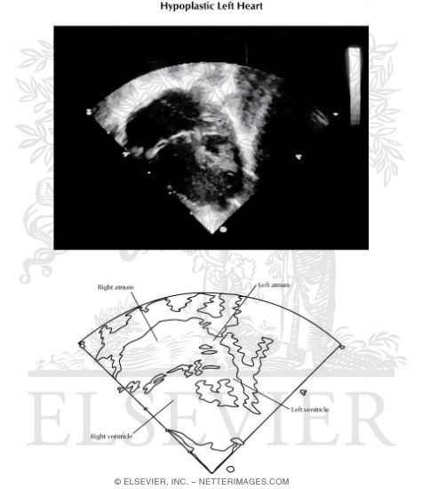 Watermarked preview of labeled image: Hypoplastic Left Heart