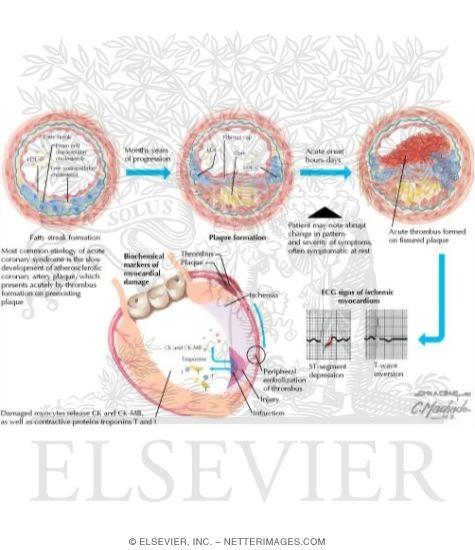 Pathophysiology of Acute Coronary Syndromes