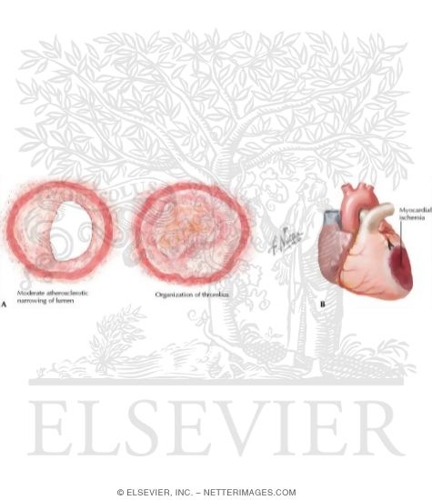 Myocardial Infarction
