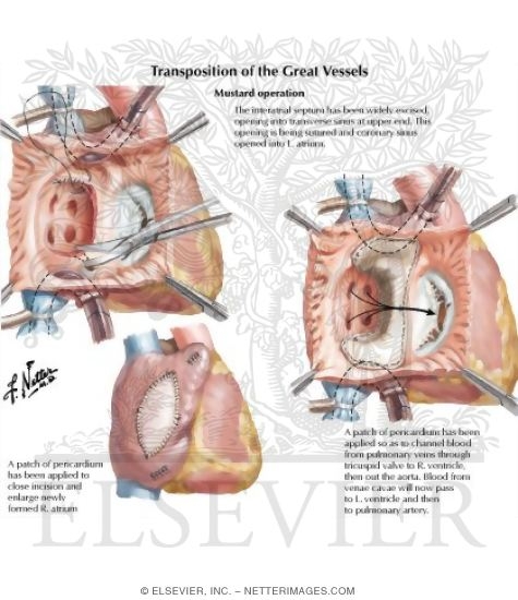 Transposition of the Great Vessels